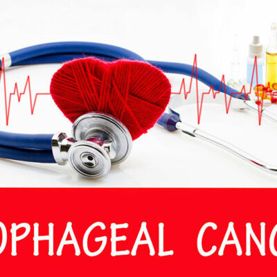 Esophageal cancer – Signs, causes, and management