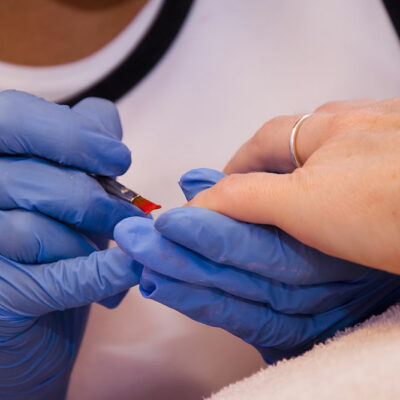 Nail fungal infection – Causes, symptoms, and management